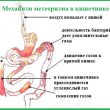 Причины, диагностика, лечение и профилактика метеоризмов