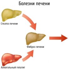 Перечень основных заболеваний печени